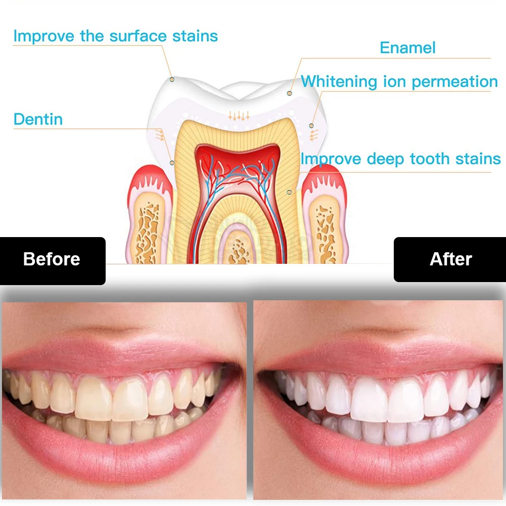 Dental Teeth Whitening Kit Min - Teeth Whitening Near Me 评论和价格
